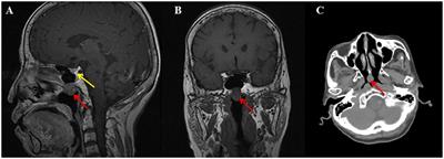 Central hyperthyroidism due to an ectopic TSH-secreting pituitary tumor: a case report and literature review
